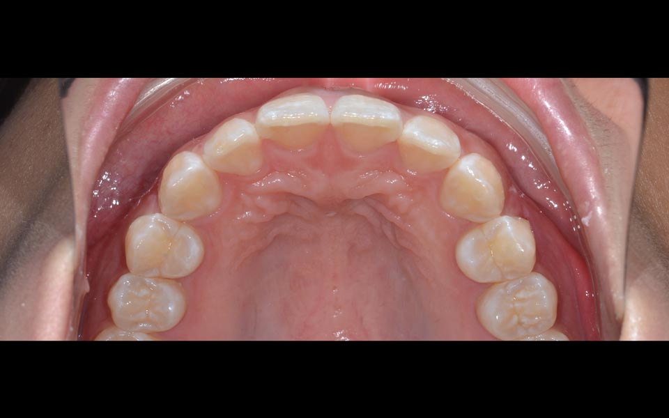 Orthodontic relapse after